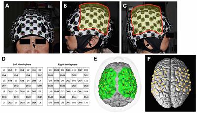 Changes in Motor-Related Cortical Activity Following Deep Brain Stimulation for Parkinson’s Disease Detected by Functional Near Infrared Spectroscopy: A Pilot Study